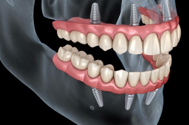 ایمپلنت کامل کل دهان ( + هزینه )